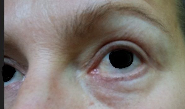 Reprise possible blépharoplastie inférieure ? - 82729