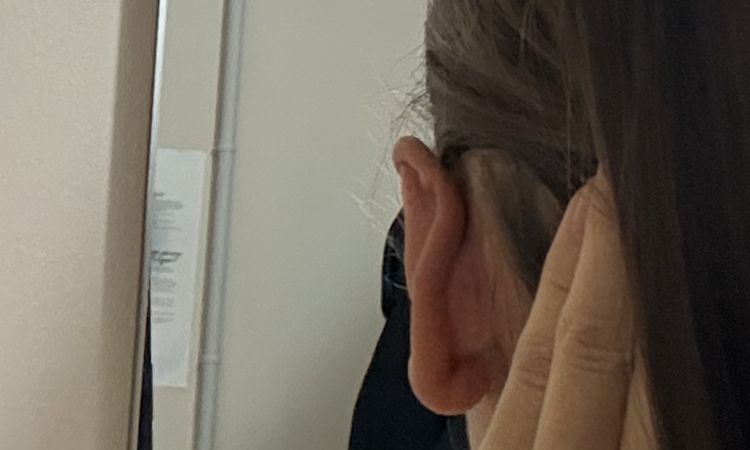 Otoplastie oreilles asymétriques - 82733