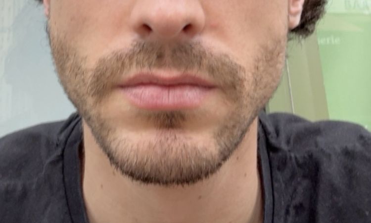 Peau jeune relâchée post hyaluronidase - 82834