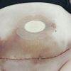 Oedème et ecchymoses post abdominoplastie