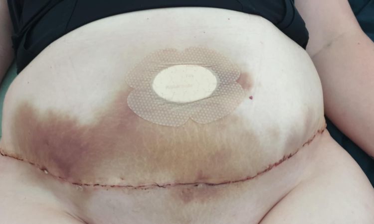 Oedème et ecchymoses post abdominoplastie - 82854