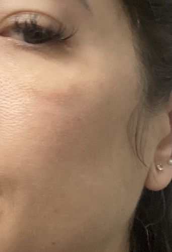 Skinbooster et grosses poches sur pommettes/vallée des larmes
