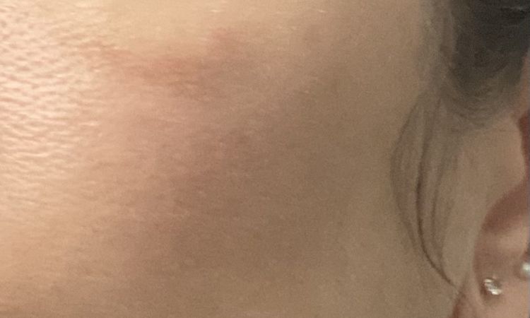 Skinbooster et grosses poches sur pommettes/vallée des larmes - 82859