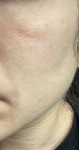 Skinbooster et grosses poches sur pommettes/vallée des larmes