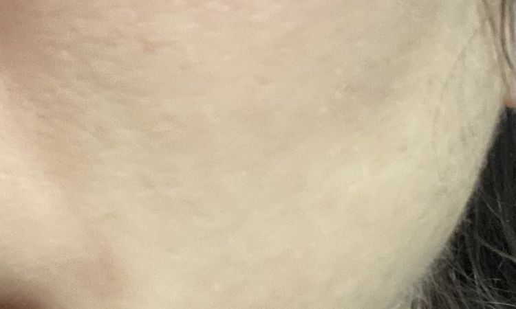 Skinbooster et grosses poches sur pommettes/vallée des larmes - 82860