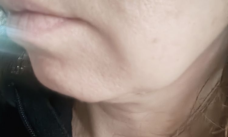 Traitement des bajoues à 45 ans - 82864