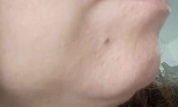 Traitement des bajoues à 45 ans - 82865