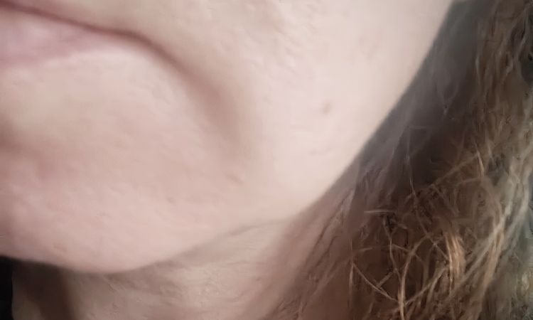 Traitement des bajoues à 45 ans - 82866