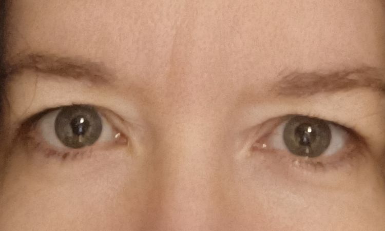 Indication blépharoplastie - 83216