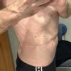 Avis post-liposuccion