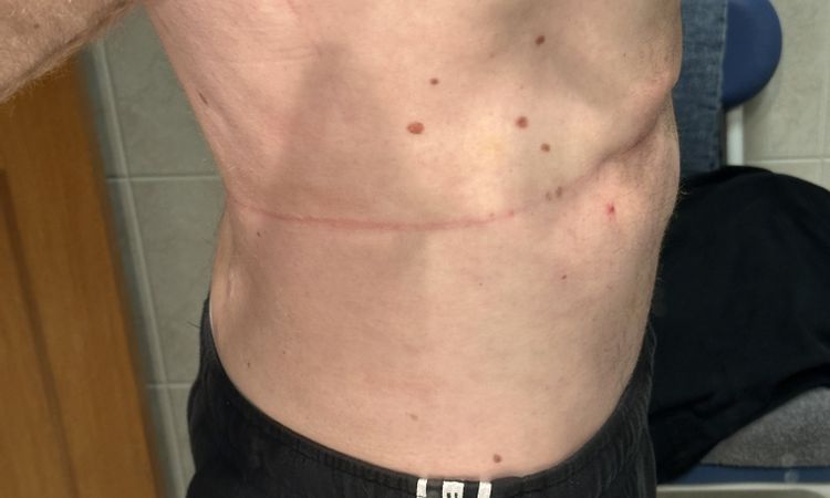 Avis post-liposuccion - 83577