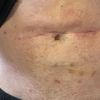 Avis post-liposuccion