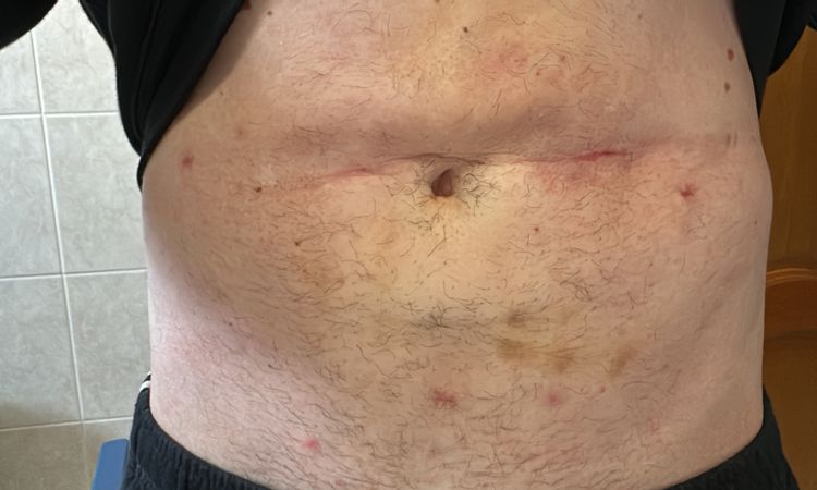 Avis post-liposuccion - 83578