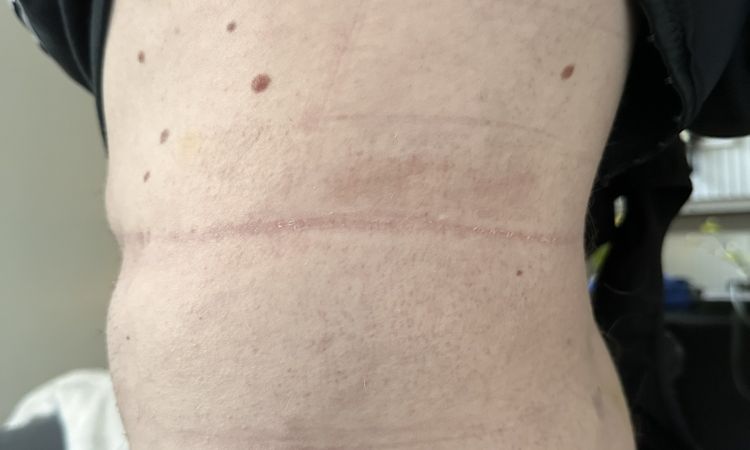 Avis post-liposuccion - 83579