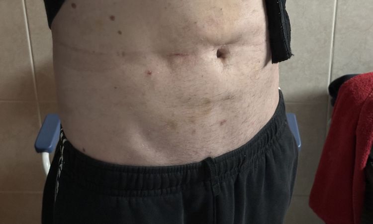 Avis post-liposuccion - 83580