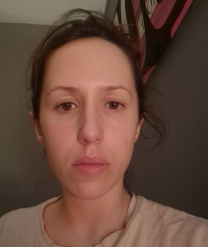 Une génioplastie peut-elle améliorer l'harmonie du visage ?