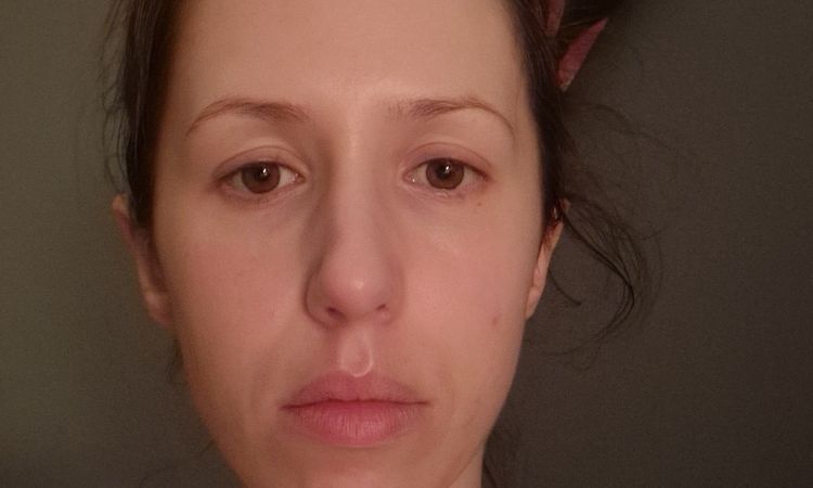 Une génioplastie peut-elle améliorer l'harmonie du visage ? - 83598