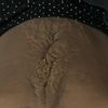 Excédent de peau après hernie ligne blanche et diastasis