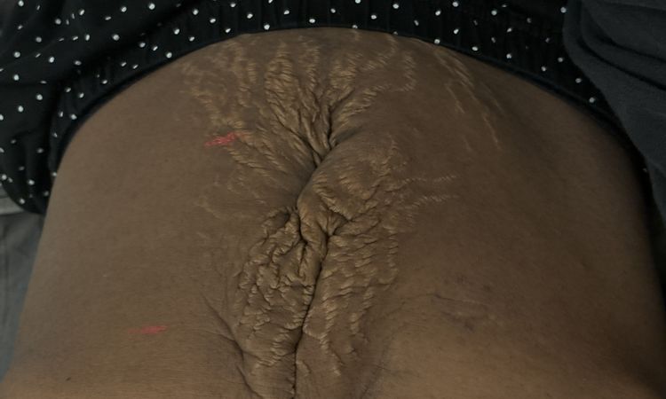 Excédent de peau après hernie ligne blanche et diastasis - 83968