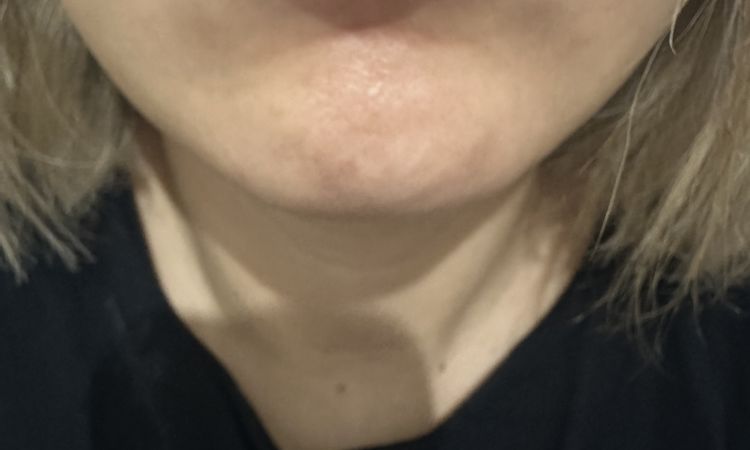 Bonjour, j’ai fais des injection d’AH aux levres il y a 9 jours. - 84131