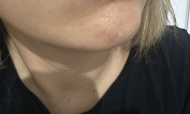 Bonjour, j’ai fais des injection d’AH aux levres il y a 9 jours. - 84132