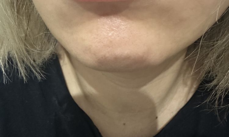 Bonjour, j’ai fais des injection d’AH aux levres il y a 9 jours. - 84133