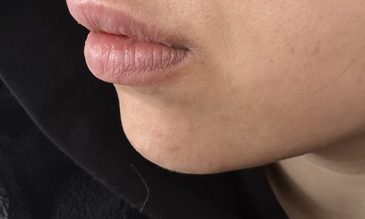 Bonjour, j’ai fais des injection d’AH aux levres il y a 9 jours. - 84134