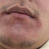 Taches Hyperpigmentation