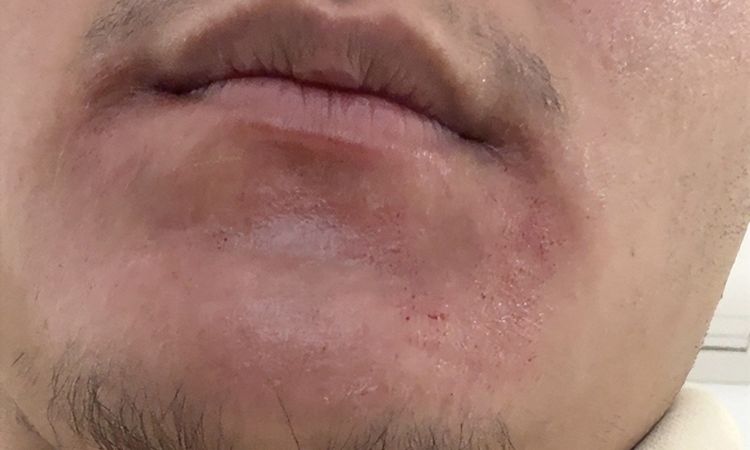Taches Hyperpigmentation - 84387