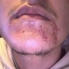 Taches Hyperpigmentation