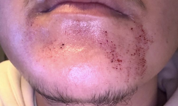 Taches Hyperpigmentation - 84388