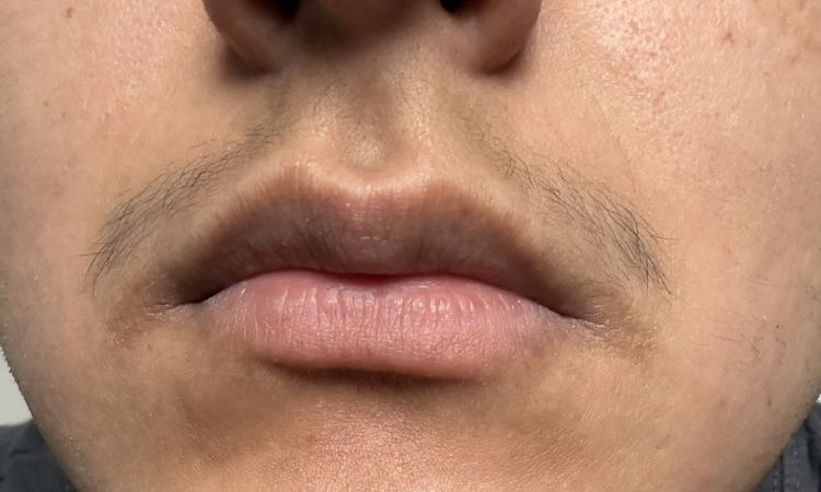 Taches Hyperpigmentation - 84389