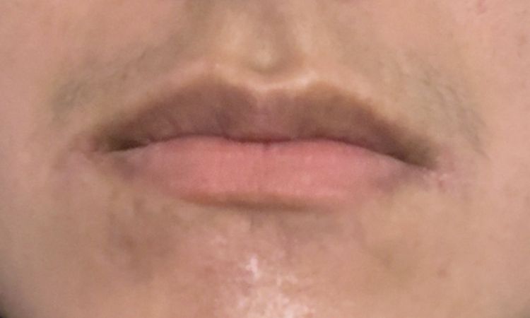Taches Hyperpigmentation - 84390