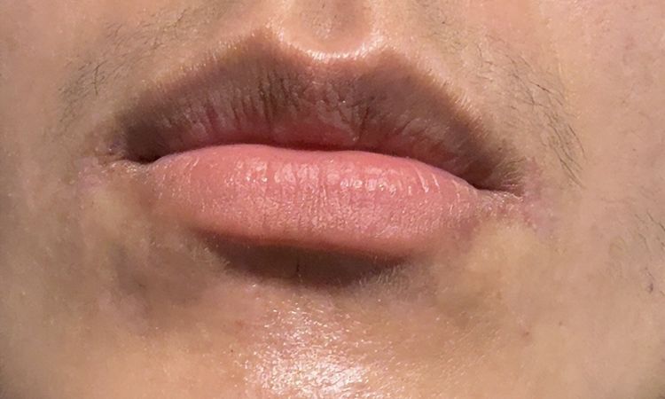 Taches Hyperpigmentation - 84391