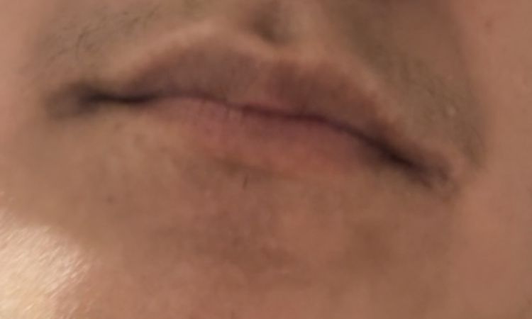 Taches Hyperpigmentation - 84392