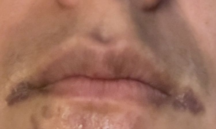 Taches Hyperpigmentation - 84393