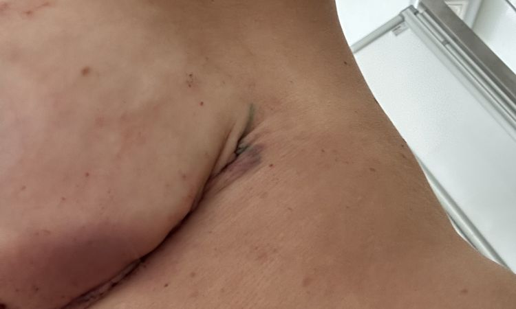 Chirurgie changement d implants, ptôse, ratée - 84958
