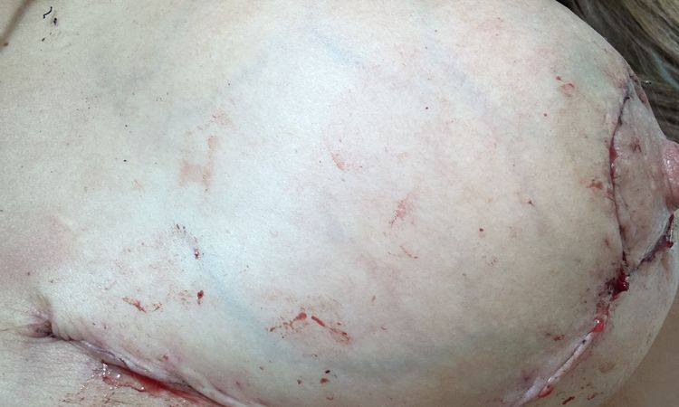 Chirurgie changement d implants, ptôse, ratée - 84959