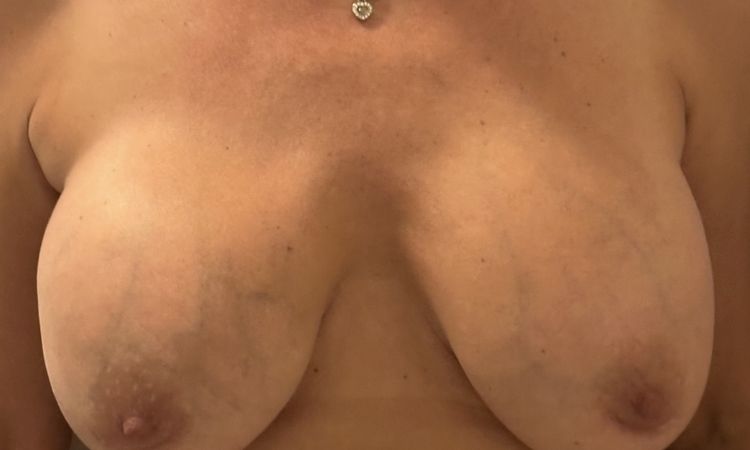 Chirurgie changement d implants, ptôse, ratée - 84962
