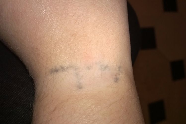 Enlever un tatouage