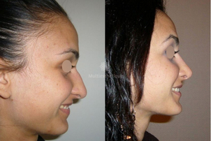 avant / après rhinoplastie
