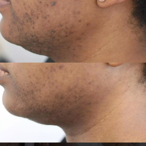 avant / après taches pigmentaires