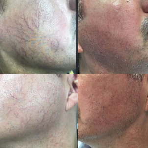 varices avant après