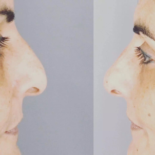 rhinoplastie médicale avant après