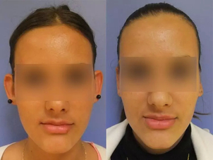 otoplastie avant / après