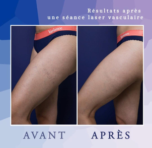 avant / après laser dermatologique