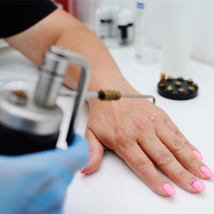 Traitement d'une verrue