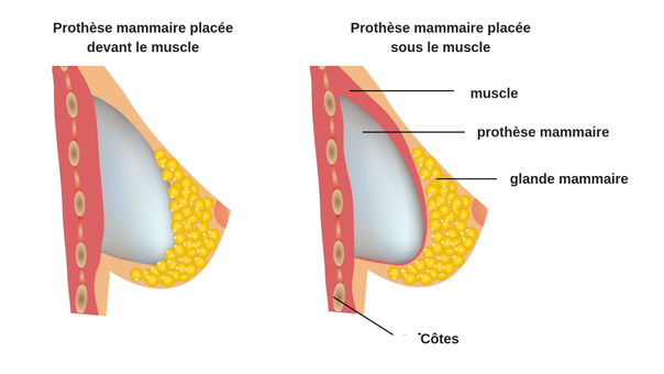 Techniques d'augmentation mammaire