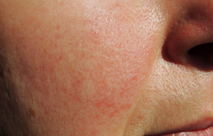 Zoom sur la rosacée