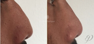 rhinoplastie médicale avant après